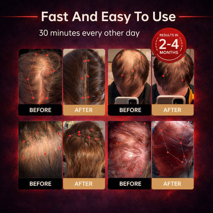 Revive Light Therapy™ Hat Clinically Tested Red Light for Hair Regrowth - stavogue
